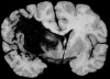 Hypertensive putaminal hemorrhage